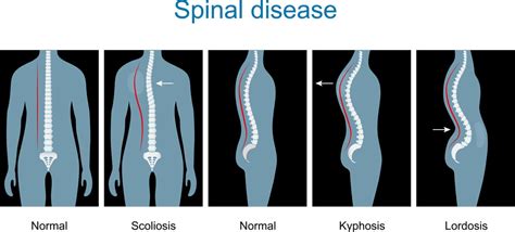 Understanding the Origins of Excruciating Spinal Discomfort: Factors to Consider