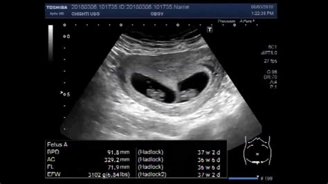 Understanding the Process of Twin Ultrasound Scans