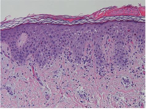 Understanding the Psychological Impacts of Epidermal Lesions