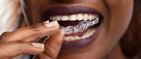 Understanding the Purpose of a Dental Shield