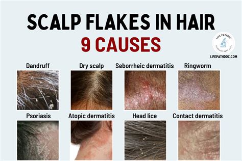 Understanding the Reasons and Triggers of Intense Scalp Flaking