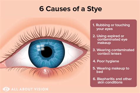 Understanding the Root Causes of an Eye Stye