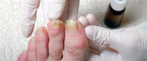 Understanding the Science Behind the Yellowing of Nails