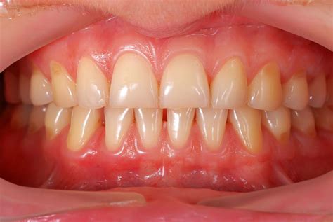 Understanding the Significance of Healthy Gum Tissues