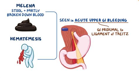 Understanding the Significance of Hematemesis: Underlying Factors and Associated Medical Conditions