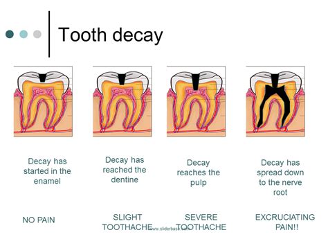 Understanding the Symbolism Behind the Absence of a Decayed Tooth