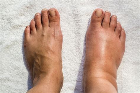 Understanding the Underlying Factors of Foot Swelling: