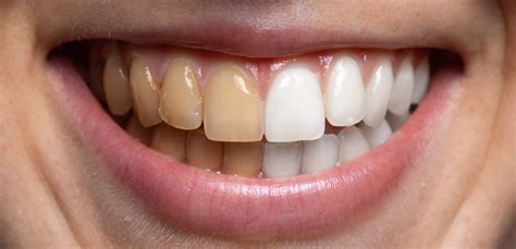 Understanding the Yellowing of Teeth: Origins and Remedies