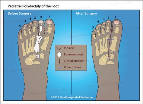 Unlocking the Intriguing Significance of Foot Digit Extraction in Dream Analysis