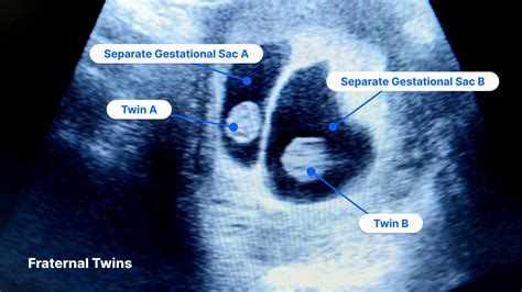 Unlocking the Mysteries: Unveiling the Hidden Aspects of Twin Ultrasound