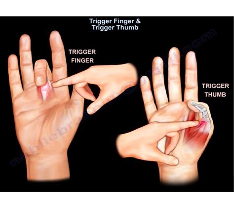 Unraveling Possible Physical Triggers for Envisioning Nails Embedded Within the Physical Form