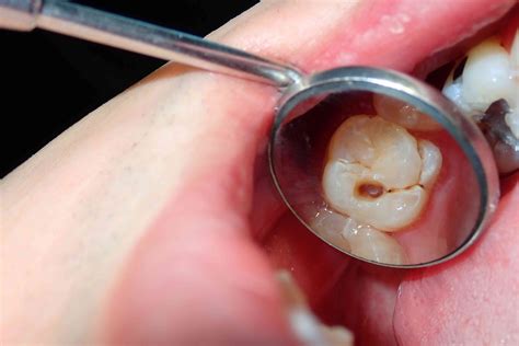 Untreated Cavities: A Gateway to Dental Infections