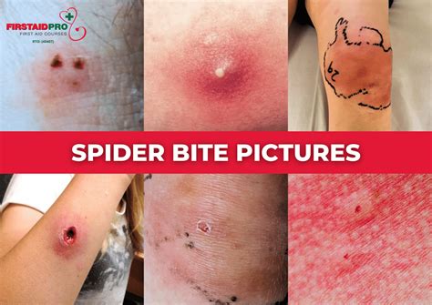 Unveiling Personal Associations: What Does a Spider Bite Mean to You?