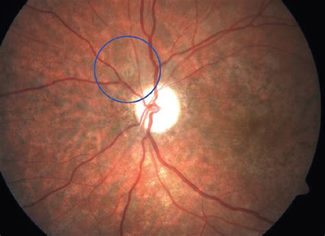 Unveiling the Hidden Significance: Analyzing the Presence of a Worm in the Optic Region