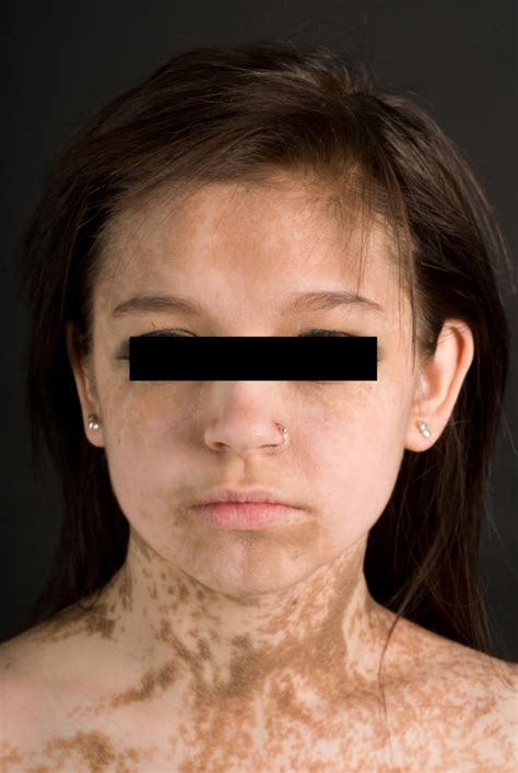 Unveiling the Hidden Significance of Facial Epidermal Detachment Fantasies