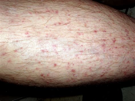 Unveiling the Hidden Significance of a Skin Eruption on Your Lower Limbs