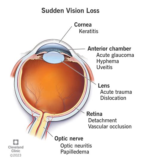 Unveiling the Meaning Behind Losing Vision in the Left Eye