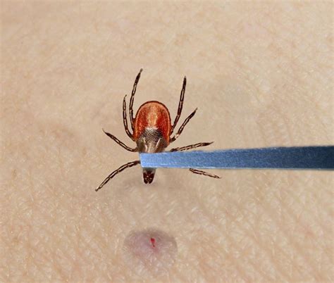 Unveiling the Pleasure of Removing Ticks: Experiencing the Joy of a Pristine Encounter