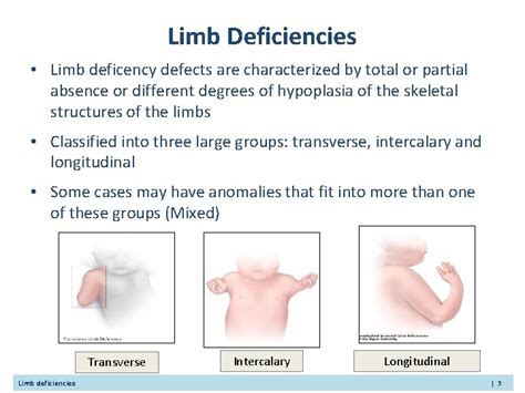 Unveiling the Significance of a Missing Limb