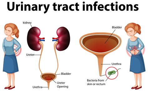 Urinary Tract Infections and the Mysterious Appearance of Red Urine: Exploring the Link