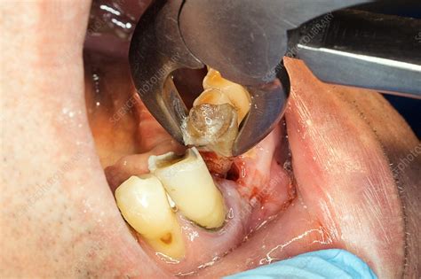 Various Approaches for Extracting Decayed Teeth