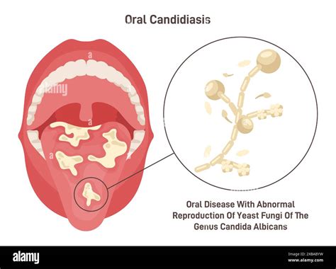 What Does the Expulsion of Mucous From the Oral Cavity Portray in Dreams?