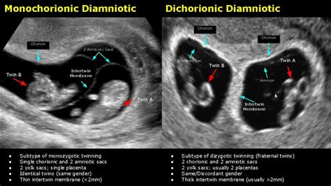 What to Anticipate: Comprehending the Mystery of Twin Ultrasound