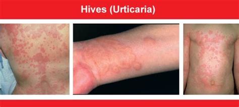 When Hives Become Severe: Recognizing Severe or Chronic Cases