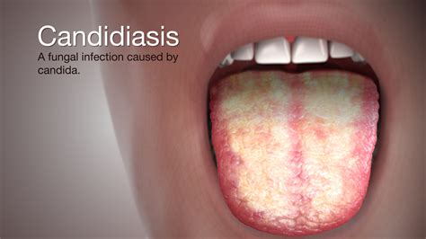 When to Seek Medical Attention for a Candidiasis