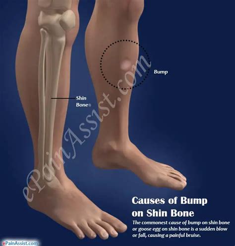 Why You Might Develop a Bump on Your Leg