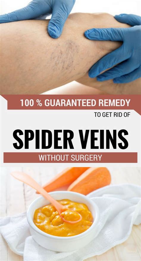 Yearning for Flawless Skin? Explore Effective Methods to Eliminate Spider Veins!
